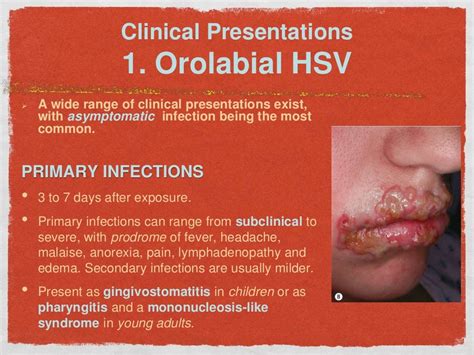 Is HSV-1 a big deal?