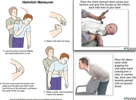 Is Heimlich maneuver the same as CPR?