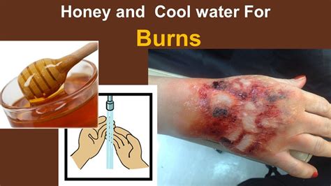 Is Honey good for burns?