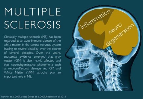 Is MS brain damage permanent?