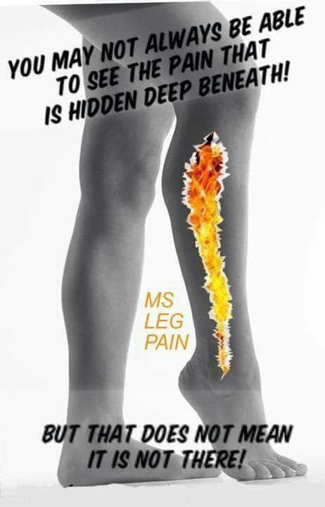 Is MS leg pain constant?