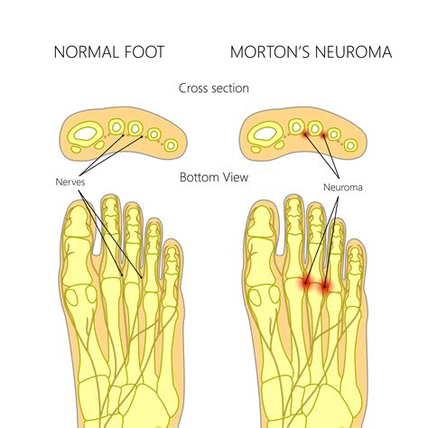 Is Morton's neuroma a disability UK?