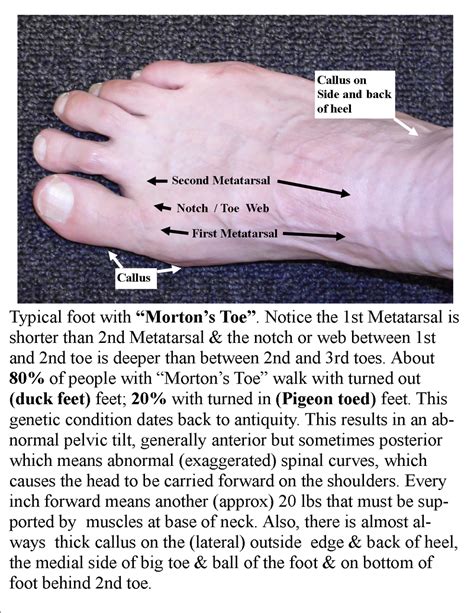 Is Morton's toe genetic?