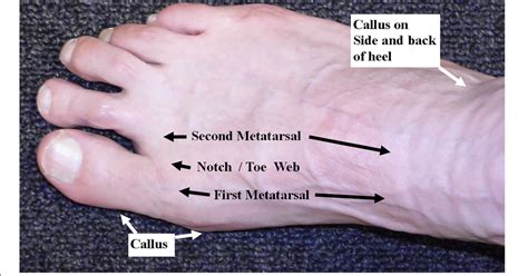 Is Morton's toe inherited?