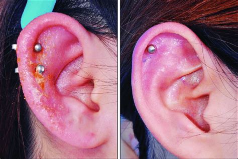 Is My piercing infected or just healing?