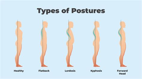 Is My posture permanent?