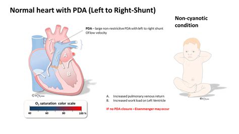 Is PDA normal in Germany?