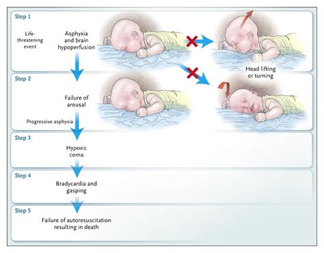 Is SIDS basically suffocation?