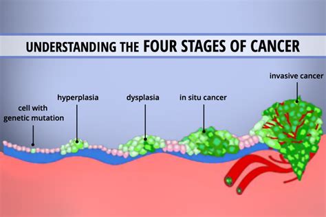 Is Stage 1 cancer serious?