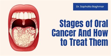 Is Stage 2 mouth cancer curable?