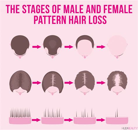 Is Stage 3 hair loss reversible?