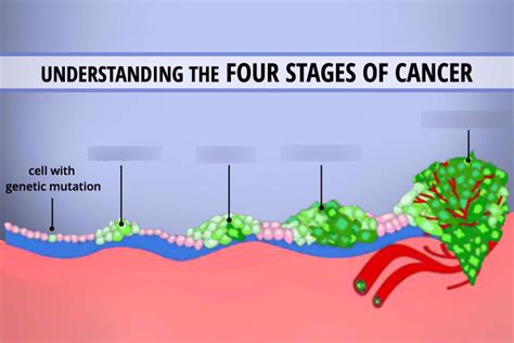 Is Stage 4 cancer guaranteed death?