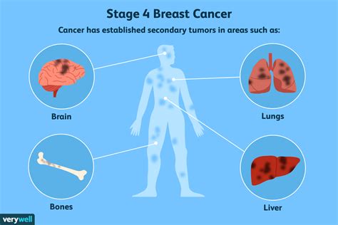Is Stage 4 cancer painful?