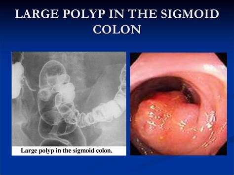 Is a 20 mm polyp cancerous?