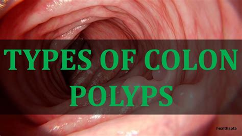 Is a 20mm polyp bad?