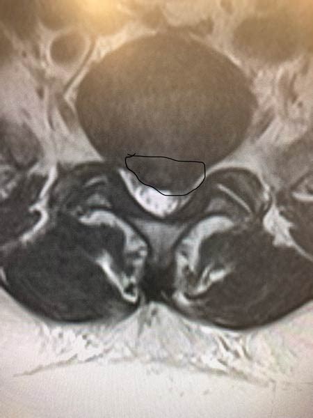 Is a 7mm disc herniation large?