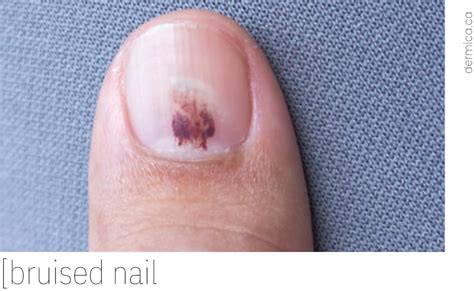 Is a bruised nail serious?