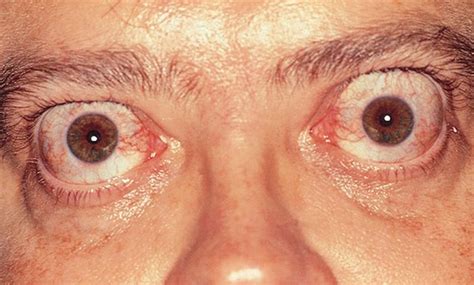 Is a bulging eye an emergency?