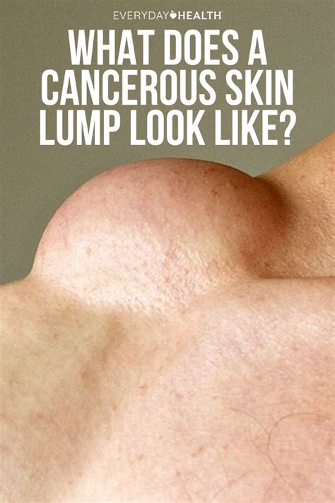 Is a cancerous lump hard or soft?