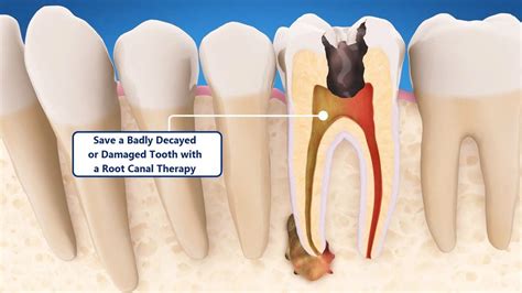 Is a dentist liable for a failed root canal?