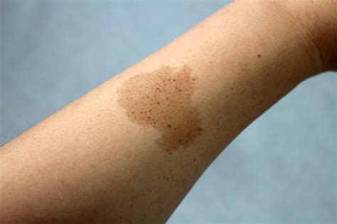Is a mole a birthmark?
