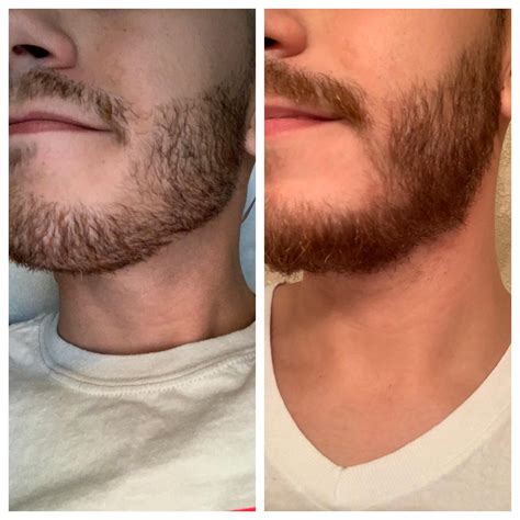 Is a patchy beard at 18 normal?
