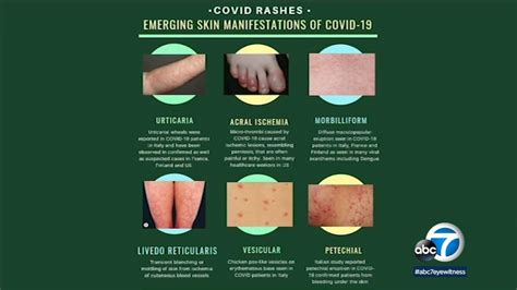 Is a rash a virus leaving the body?