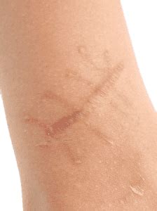 Is a scar a permanent injury?