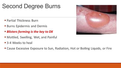 Is a second-degree burn characterized by blisters?