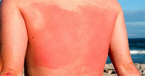 Is a sunburn worse on day 3?