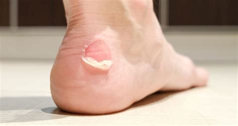 Is a white blister bad?