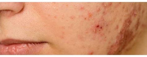 Is acne embarrassing?