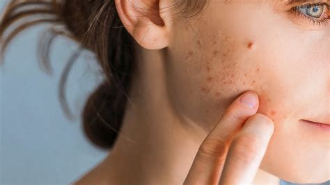 Is acne my fault?