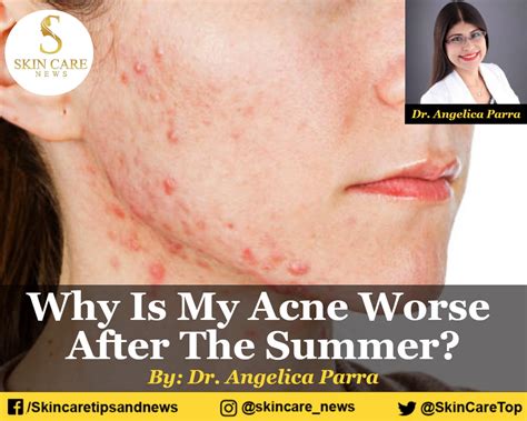 Is acne worse in summer or winter?