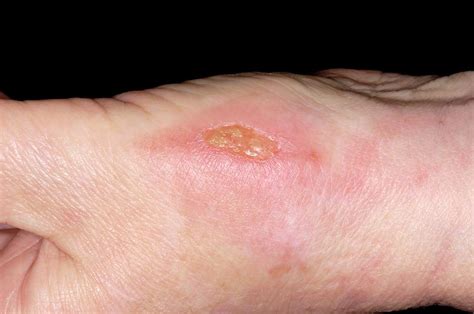 Is an infected burn yellow?