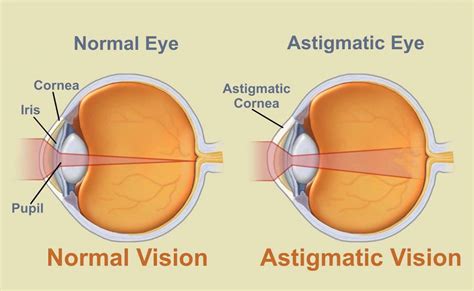 Is astigmatism 0.25 Bad?