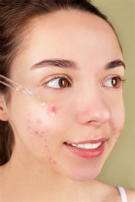 Is back acne caused by poor hygiene?