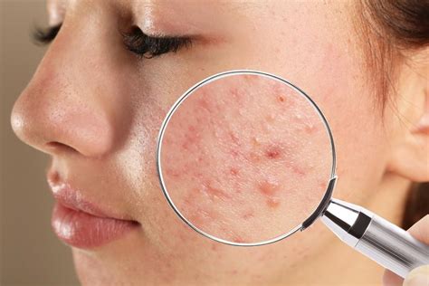 Is back acne common in girls?