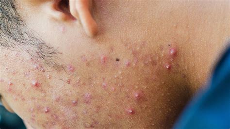 Is back acne genetic?