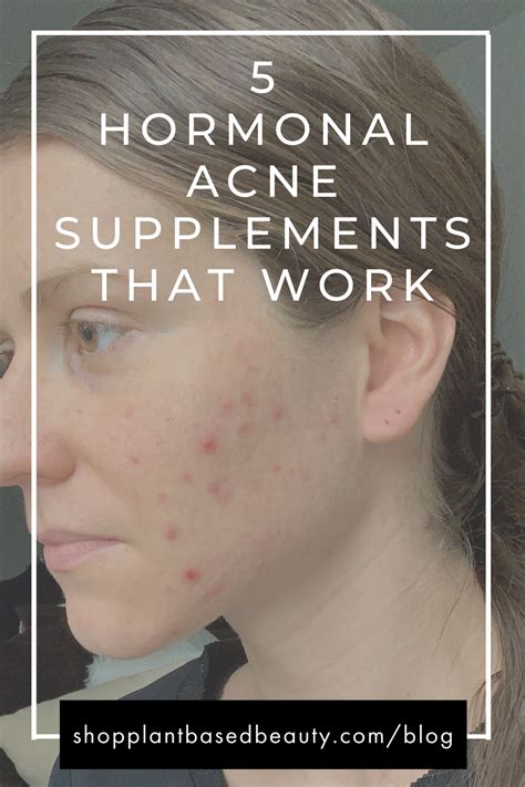 Is back acne hormonal?