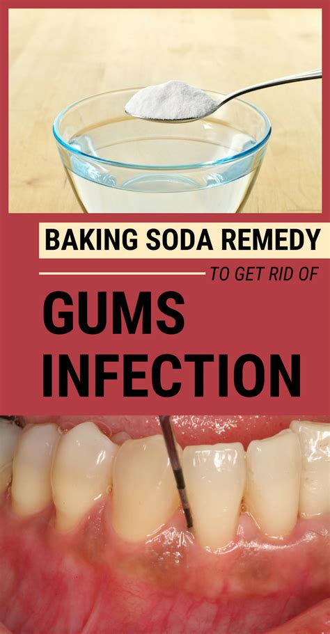 Is baking soda good for gum infection?