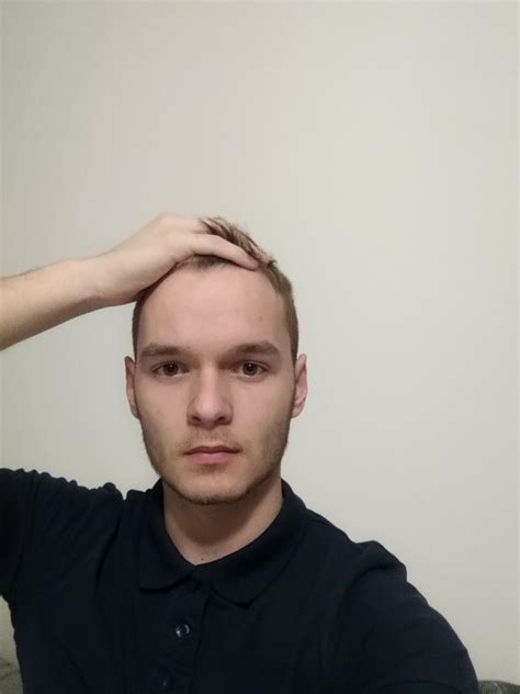 Is balding at 18 rare?