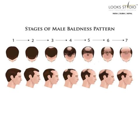 Is balding genetics or stress?
