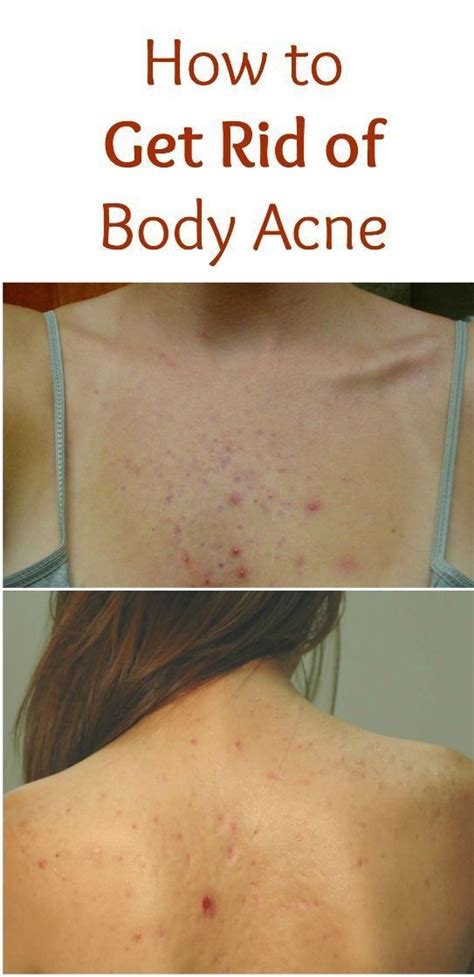 Is body acne embarrassing?