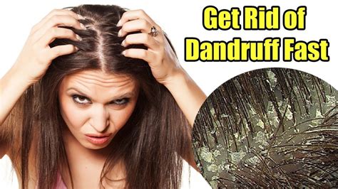 Is brushing bad for dandruff?