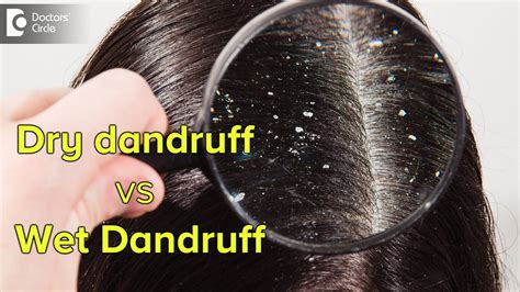Is brushing off dandruff good?