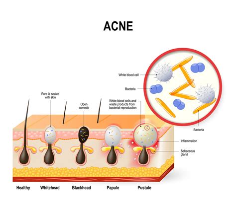 Is bum acne hormonal?