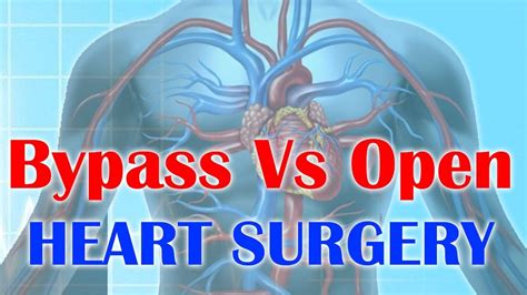 Is bypass and open heart same?