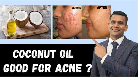 Is coconut oil good for fungal acne?