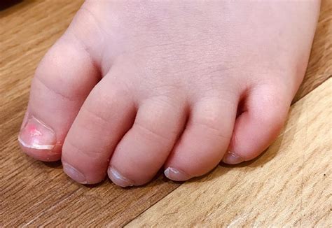 Is curly toe genetic?